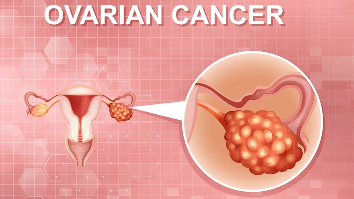 The Silent Illness: Expert Sheds Light On The Risk Factors Of Ovarian Cancer