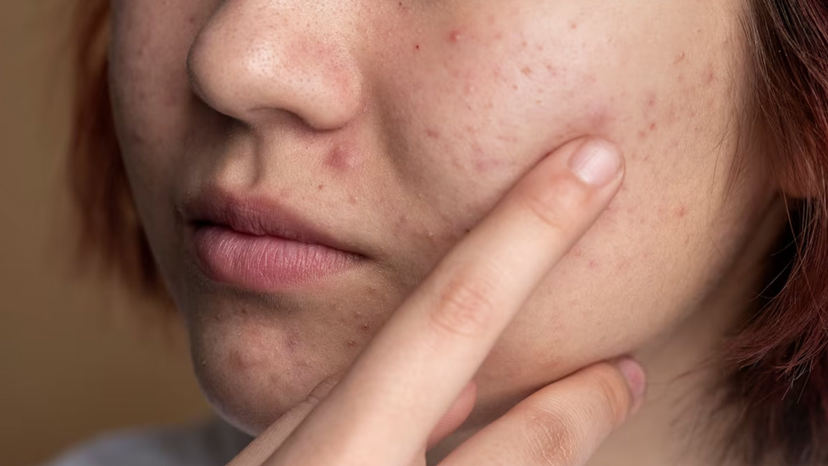 Tired Of Finding the Right Product To Combat Acne? Here’re 6 Skincare Ingredients To Look For