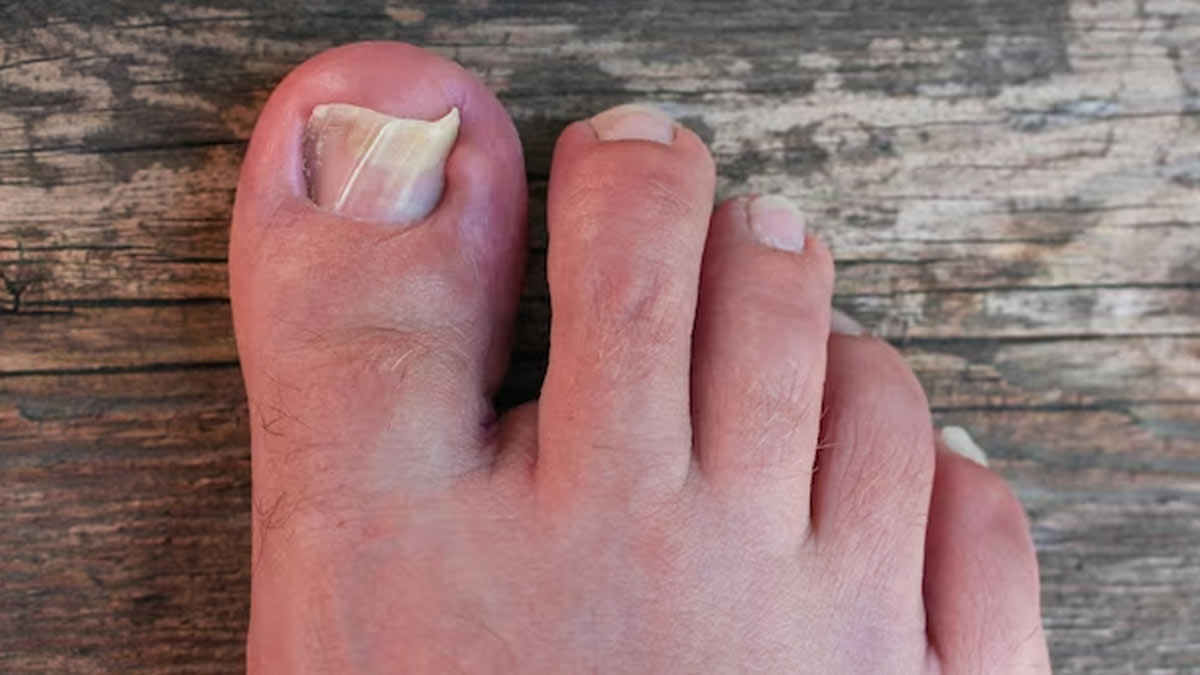 Incomplete development of the nail of the hallux in the newborn