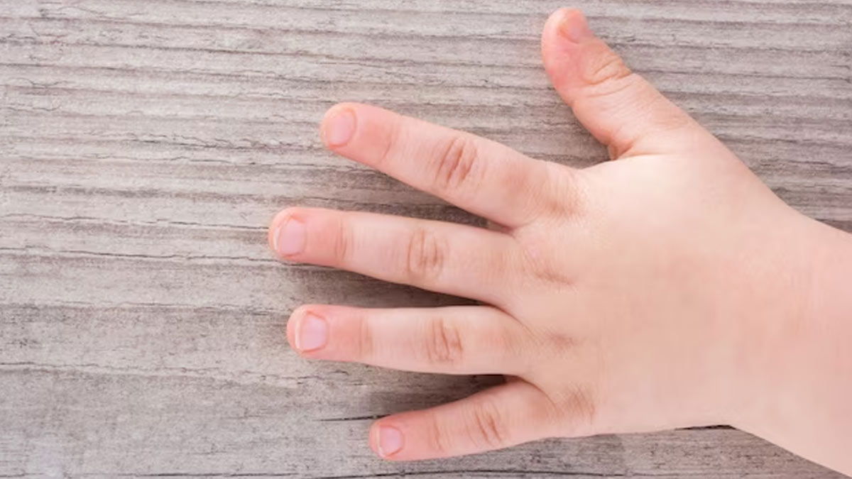  Occurence Of Sausage Fingers: Here Are 7 Possible Reasons Behind It