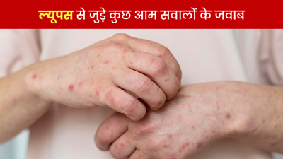 World Lupus Day 2023: ल्यूपस रोग के बारे में लोग अक्सर पूछते हैं ये 4 सवाल,  एक्सपर्ट से जानें जवाब