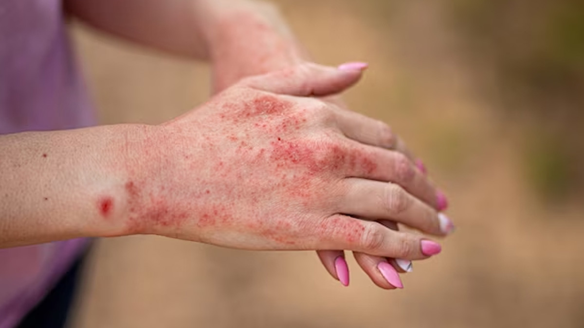 Lupus Symptoms in Hindi