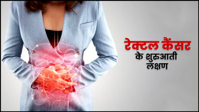 रेक्टल कैंसर की शुरुआत होने पर शरीर में दिखते हैं ये संकेत, तुरंत करवाएं इलाज