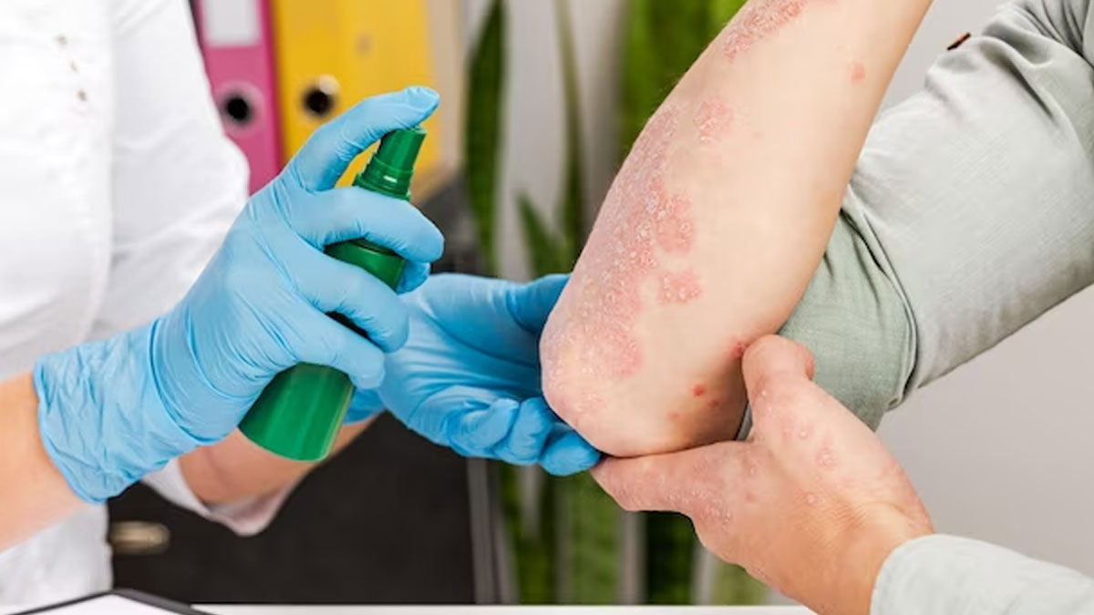 Turmeric For Fungal Infection In Hindi