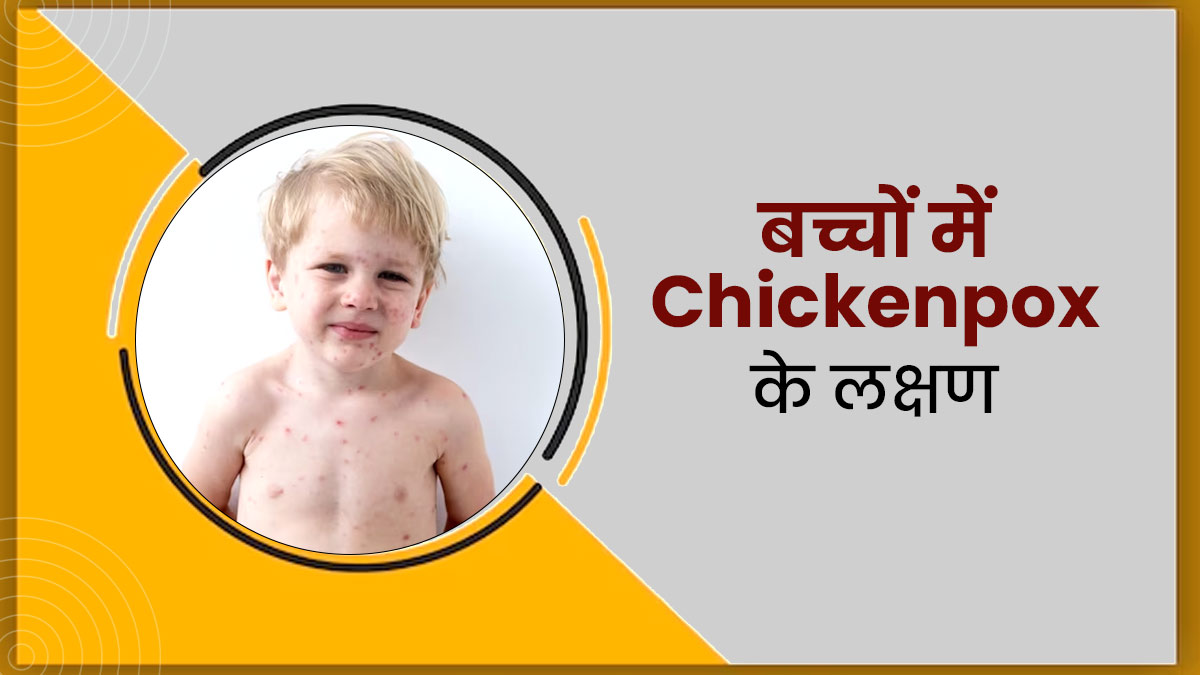 छोटे बच्चों में चिकनपॉक्स के क्या लक्षण दिखते हैं? डॉक्टर से जानें