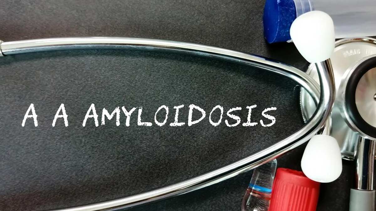 Amyloidosis: Causes, Symptoms, Diagnosis And Treatment 