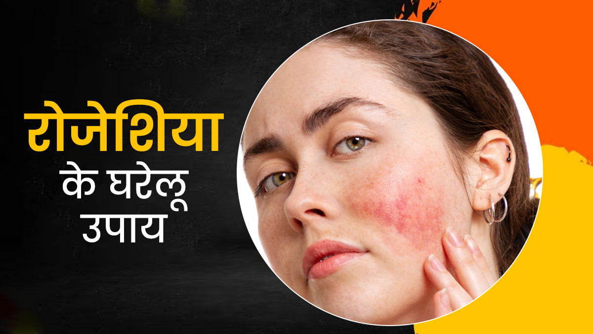 रोजेशिया (चेहरा लाल) होने पर आजमाएं ये 5 घरेलू उपाय, रेडनेस और जलन से मिलेगी राहत