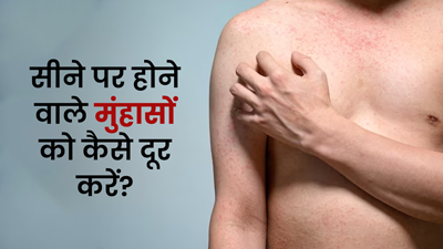 सीने पर होने वाले मुंहासों को कैसे दूर करें? जानें इसके कारण और घरेलू उपाय
