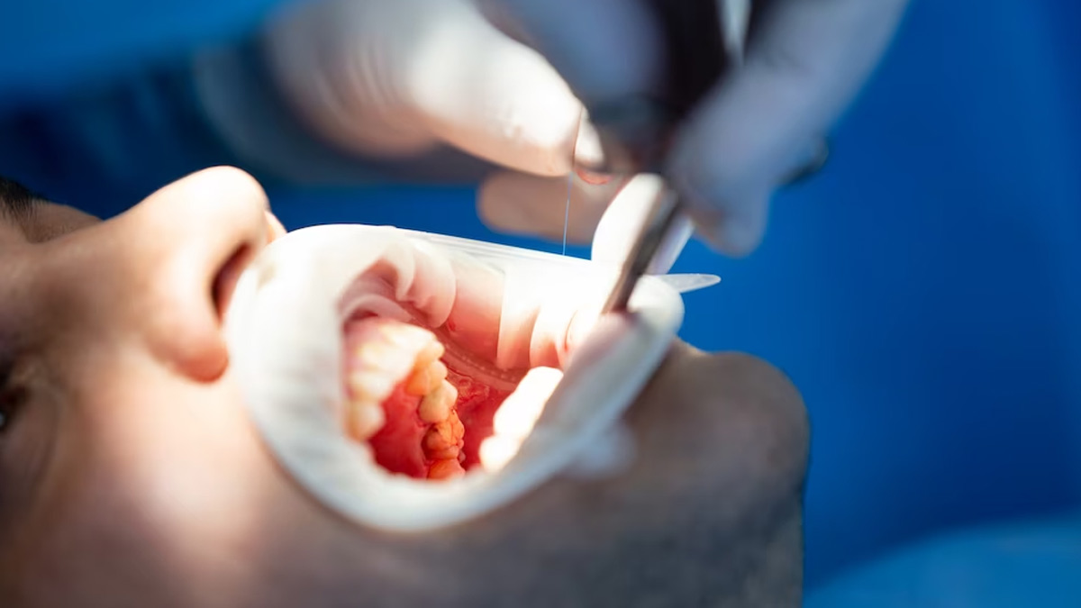 What Is Dry Socket Condition After Tooth Extraction, Dentist Explains