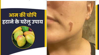 आम की चोपी लगने से त्वचा पर लाल छाले क्यों हो जाते हैं? जानें इसके लिए घरेलू उपाय
