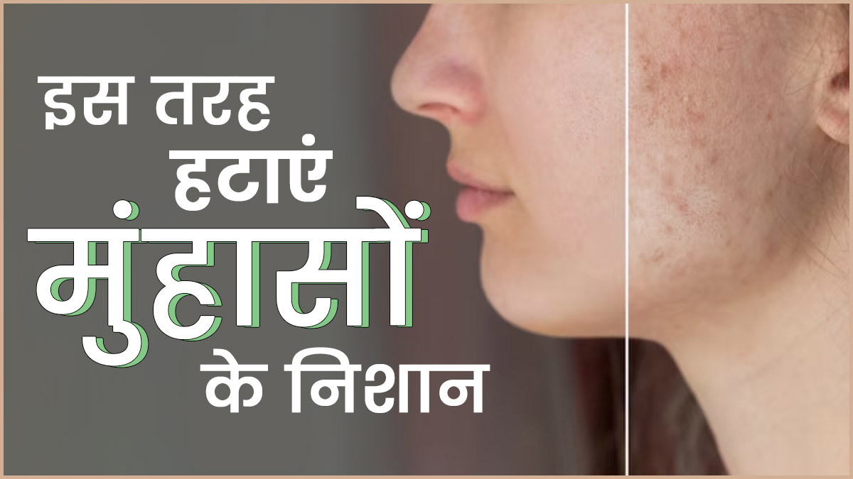मुंहासों के न‍िशान हटाने के ल‍िए चेहरे पर इस तरह लगाएं मुल्‍तानी म‍िट्टी, पाएं बेदाग त्‍वचा  