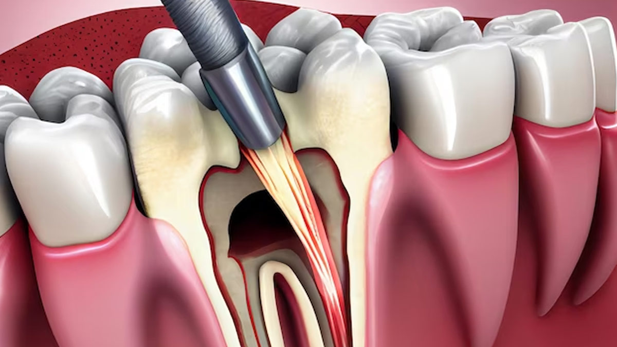 What Is Dry Socket Condition After Tooth Extraction, Dentist Explains