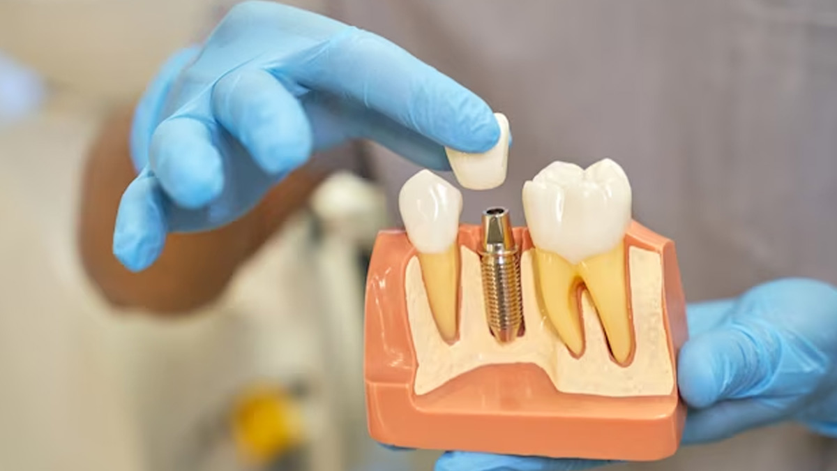 What Is Dry Socket Condition After Tooth Extraction, Dentist Explains