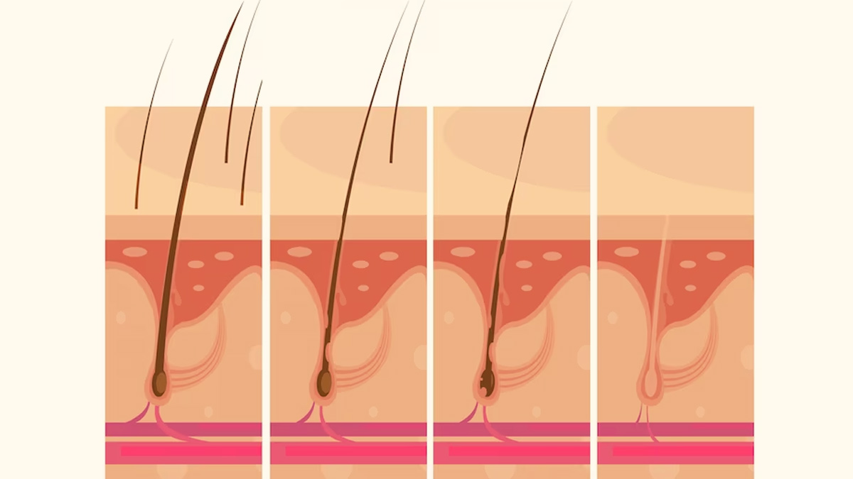 Ingrown Hair: Causes, And Treatment Options To Get Rid Of It 