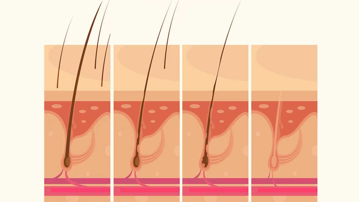 plucked hair follicle ingrown