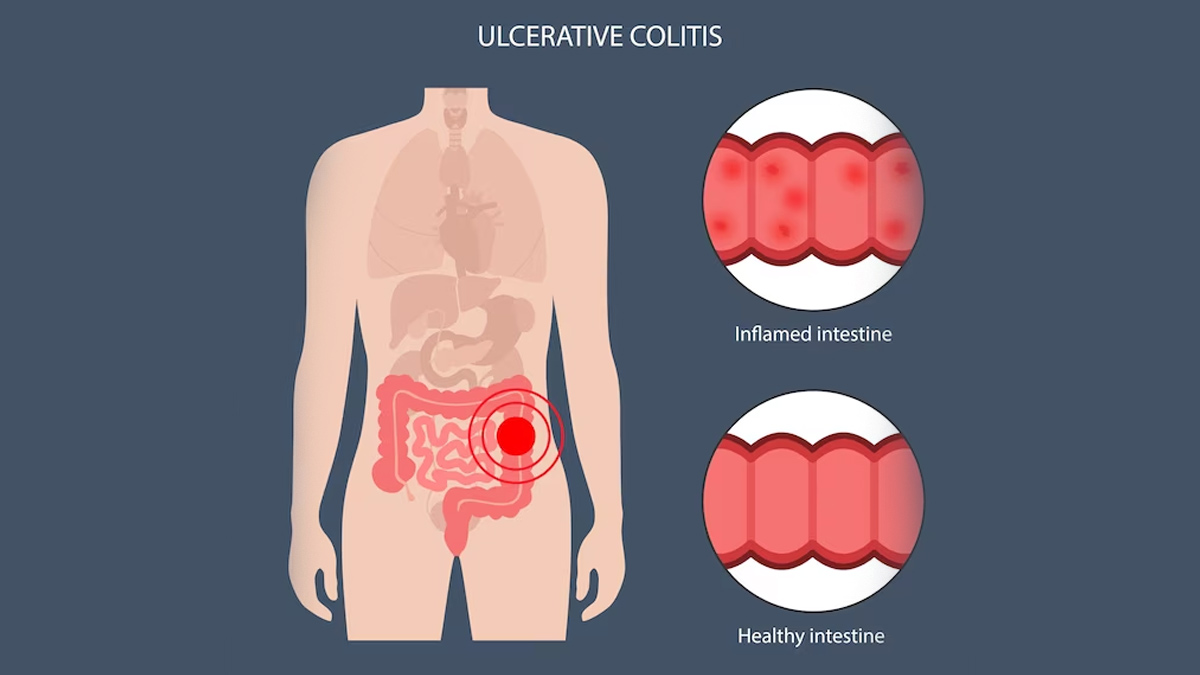 World Inflammatory Bowel Disease Day Differences Between Ulcerative Colitis And Crohns Disease 9114