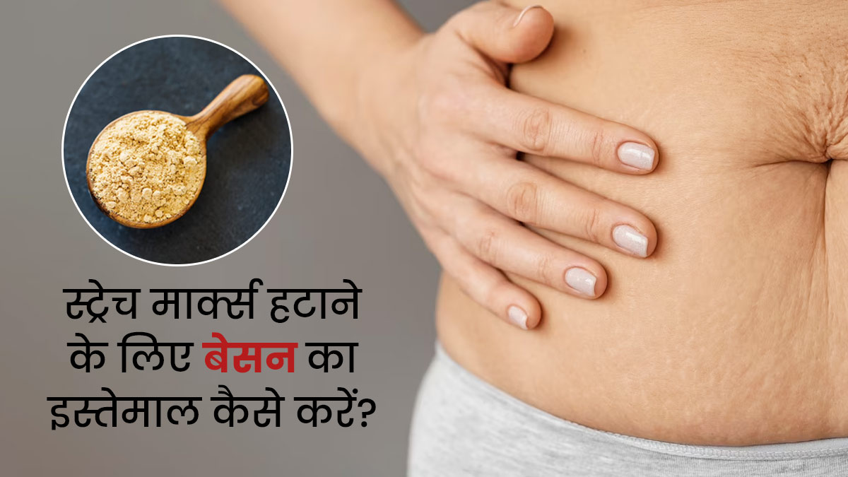 जिद्दी स्ट्रेच मार्क्स हटाने के लिए इन 4 तरीकों से करें बेसन का इस्तेमाल, जल्दी दिखेगा असर  