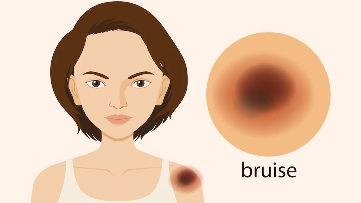 9 Reasons Why You Bruise Easily Onlymyhealth 0504