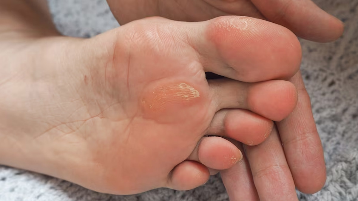 Corns And Calluses: Causes, Symptoms, Treatment And Prevention