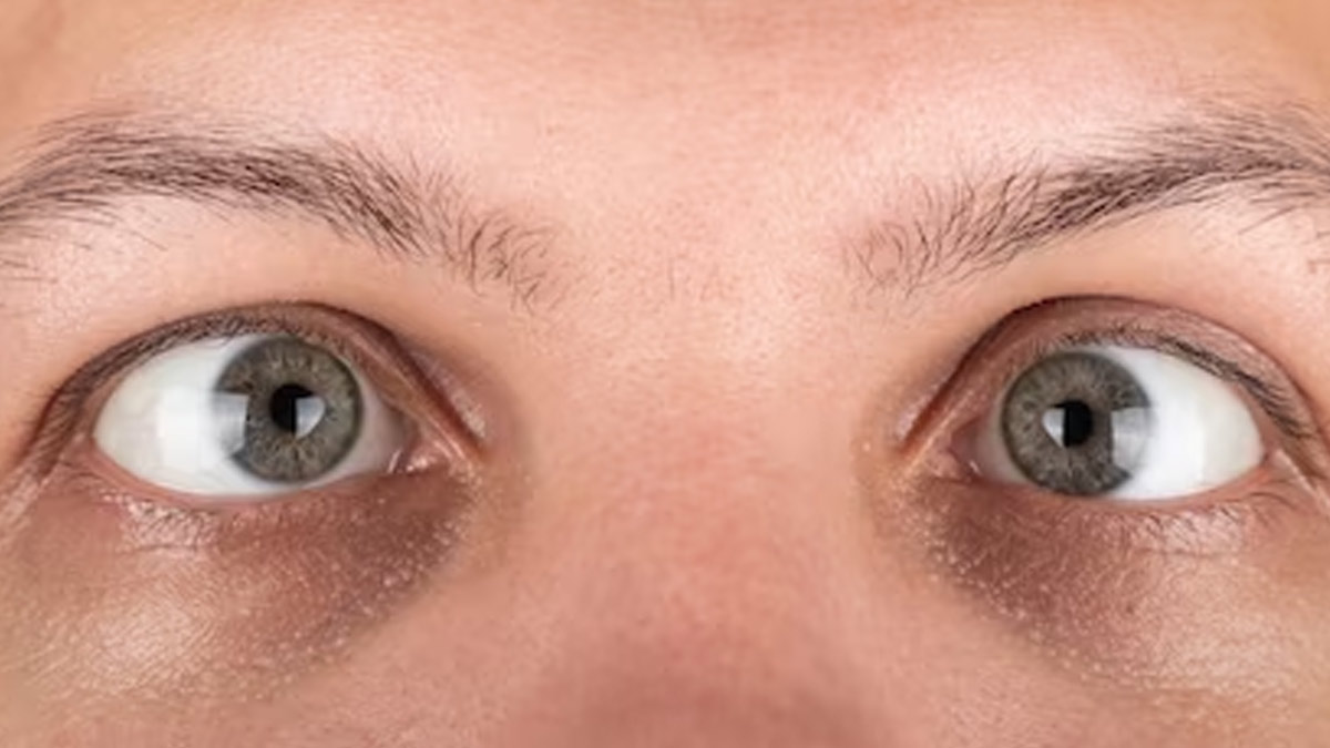 Struggling With Strabismus? Check Out For Its Symptoms, Prevention, And Treatment