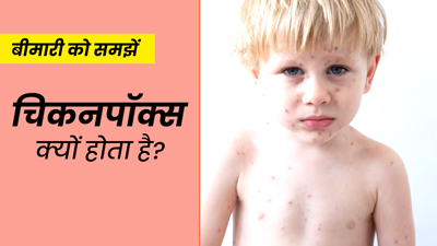 चेचक की बीमारी क्यों और कैसे होती है? डॉक्टर से आसान भाषा में समझें इसके कारण