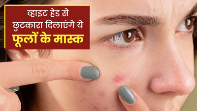 व्हाइट हेड्स से छुटकारा दिलाएगा इन 3 फूलों का फेस मास्क, जानें बनाने का तरीका