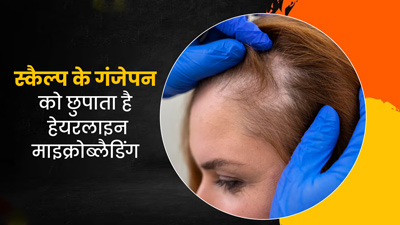 गंजापन छुपाने की तकनीक है हेयरलाइन माइक्रोब्‍लैड‍िंग, जानें इसके फायदे और नुकसान