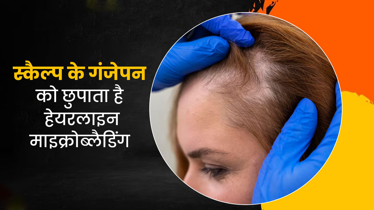 गंजापन छुपाने की तकनीक है हेयरलाइन माइक्रोब्‍लैड‍िंग, जानें इसके फायदे और नुकसान