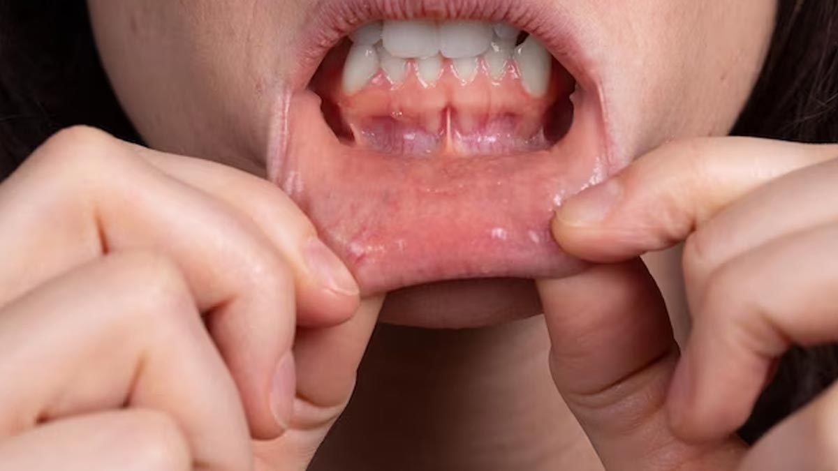 Swollen-Gums-In-Pregnancy