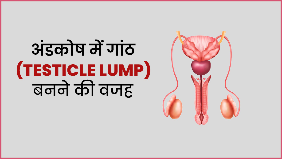 अंडकोष में गांठ (Testicle Lump) क्यों बनने लगती है? डॉक्टर से जानें कारण