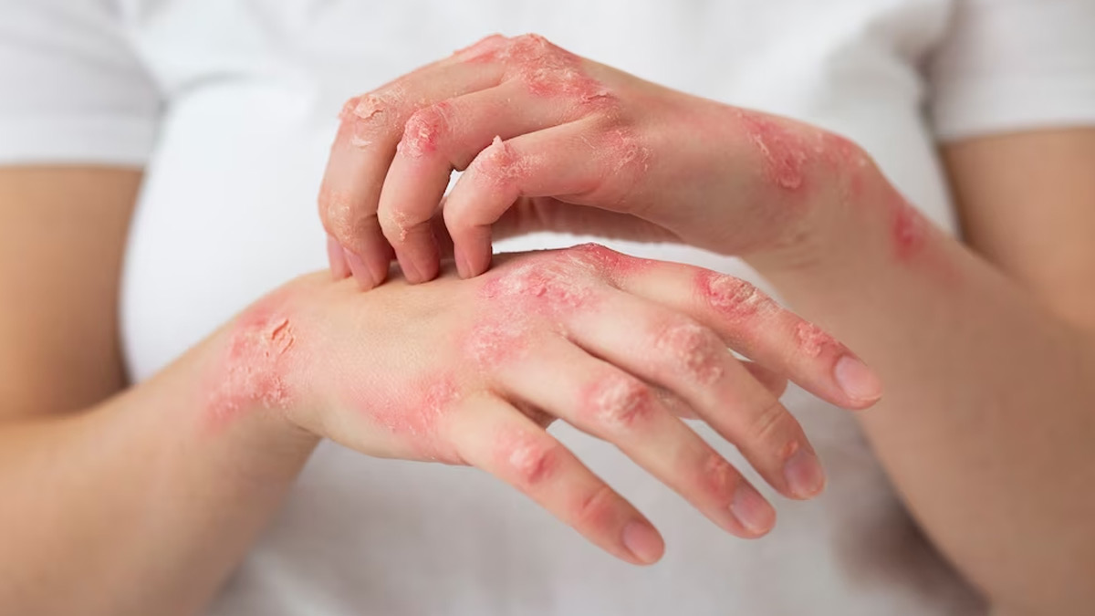 Tinea How To Prevent This Fungal Infection In Summers OnlyMyHealth