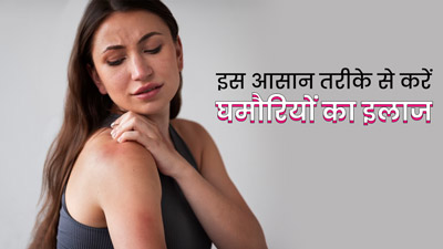 गर्मी में आलू रस से करें चुभती घमौर‍ियों का इलाज, जानें इस्तेमाल का तरीका