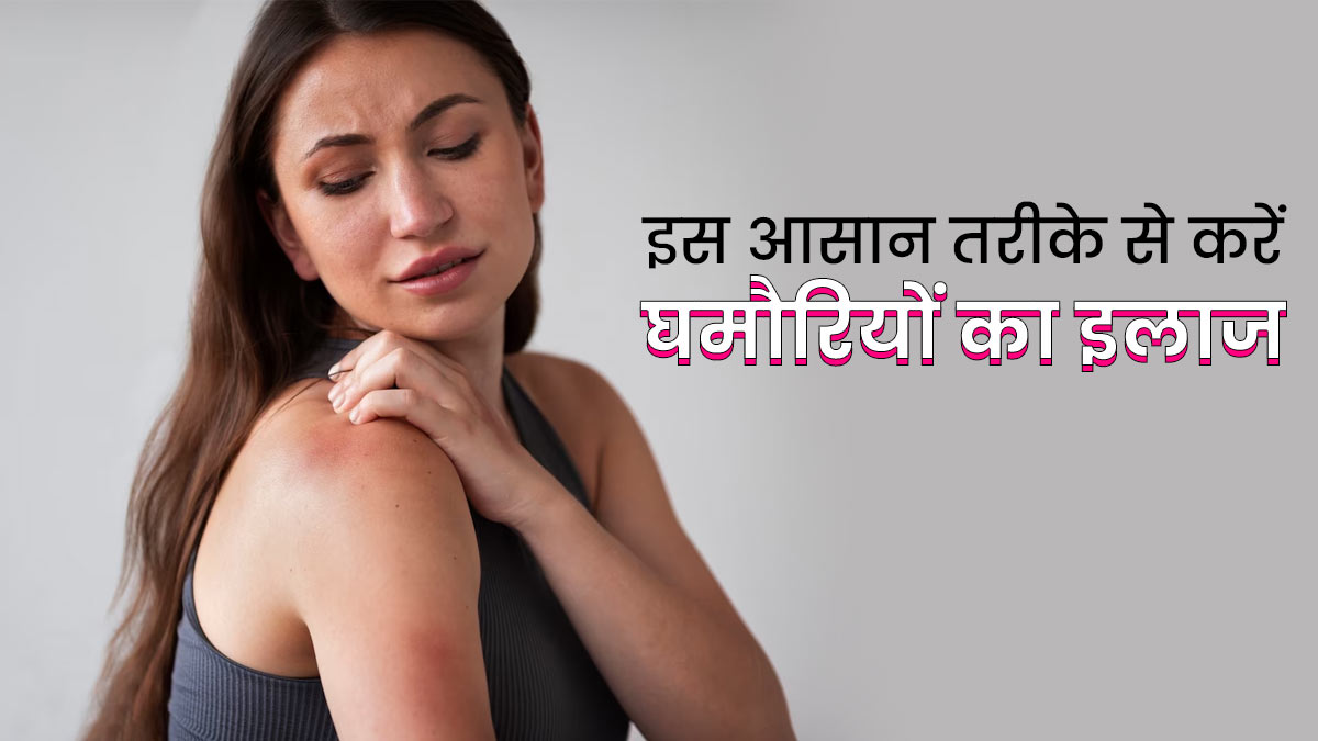 गर्मी में आलू रस से करें चुभती घमौर‍ियों का इलाज, जानें इस्तेमाल का तरीका