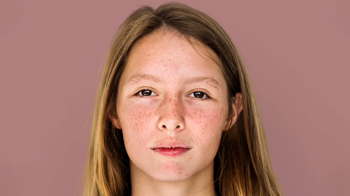 Rosacea: Triggers And Natural Remedies To Treat It