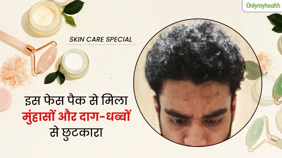 माथे पर मुंहासों और दाग-धब्बों से परेशान थे अभिनव, दीदी के बताए नीम-चंदन फेस पैक से मिला एक्ने से छुटकारा