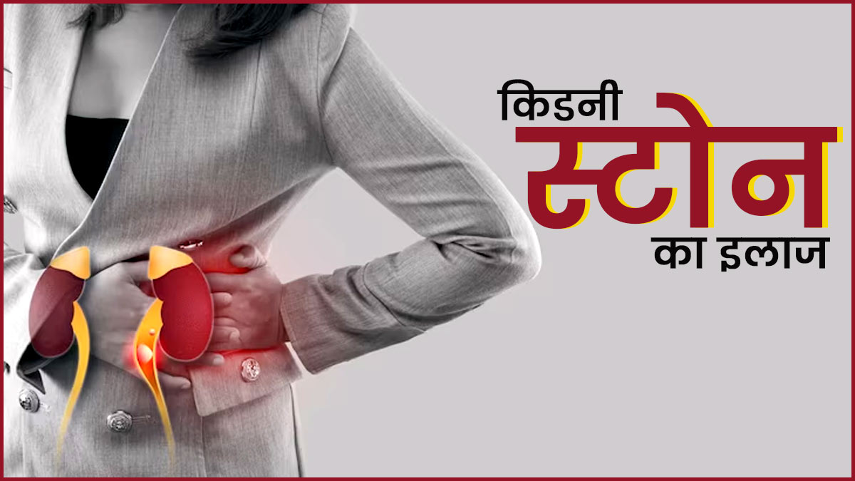 किडनी की पथरी का इलाज कैसे किया जाता है? एक्सपर्ट से जानें