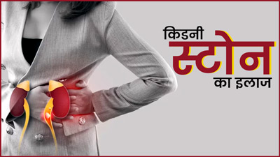 किडनी की पथरी का इलाज कैसे किया जाता है? एक्सपर्ट से जानें