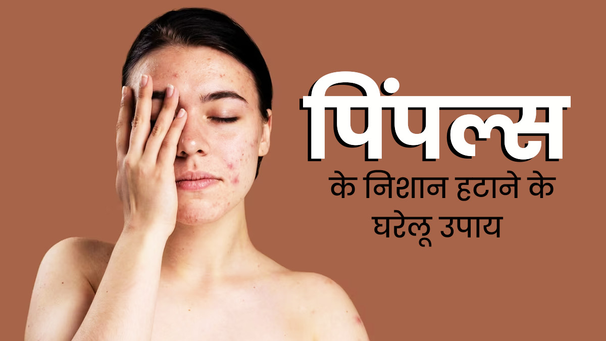 मुंहासों के निशान से छुटकारा पाने के लिए आजमाएं ये 5 घरेलू उपाय, चेहरा दिखेगा खूबसूरत
