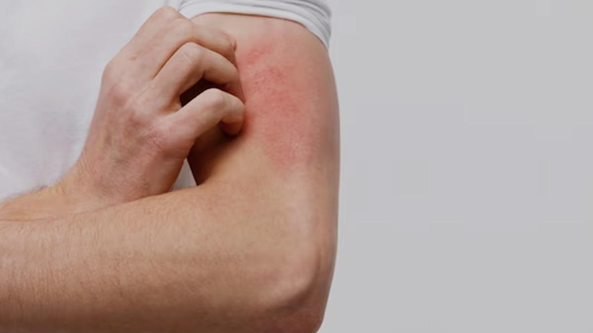 Ayurveda Remedy To Get Rid Of Allergies