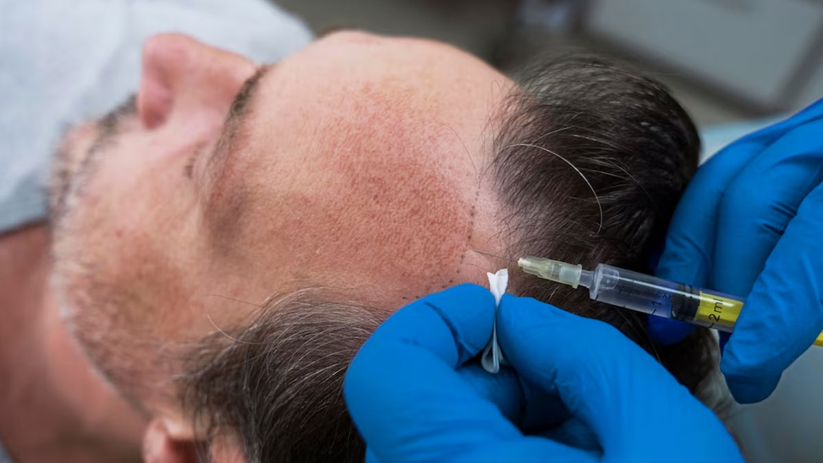 how-to-prepare-for-a-hair-transplant-onlymyhealth