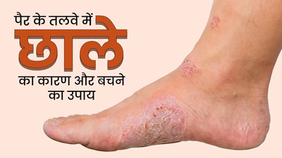 पैरों के तलवों में छाले क्यों पड़ते हैं? जानें इसके कारण और बचाव के उपाय