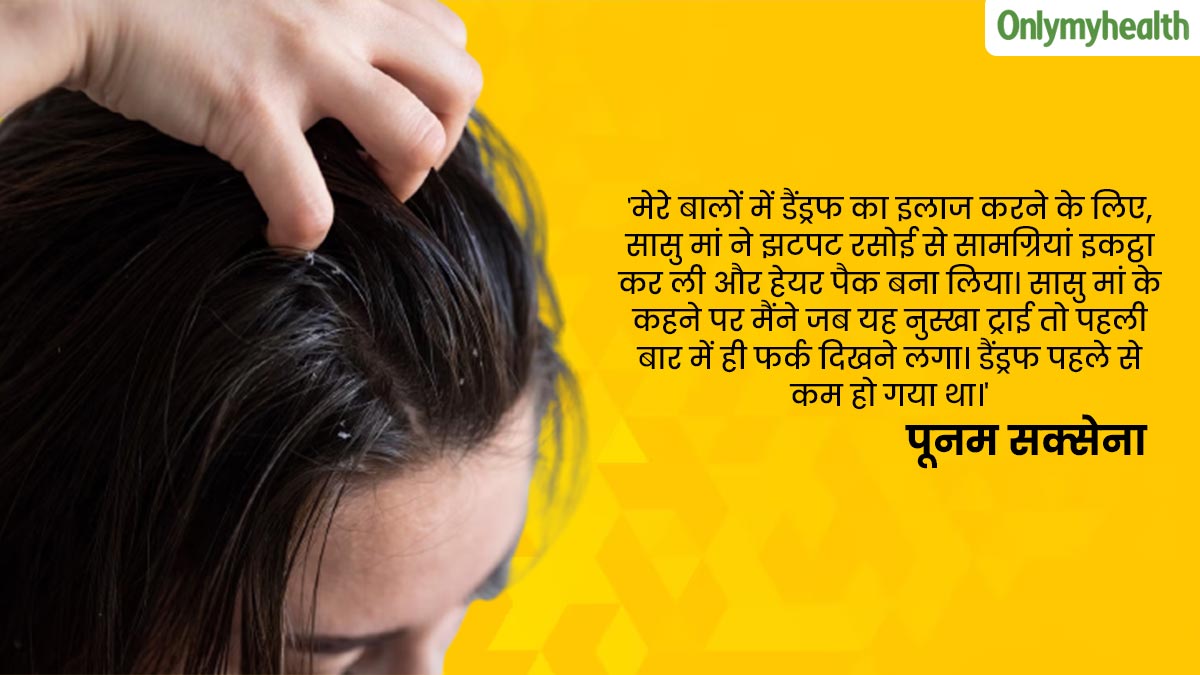 dandruff home remedy 
