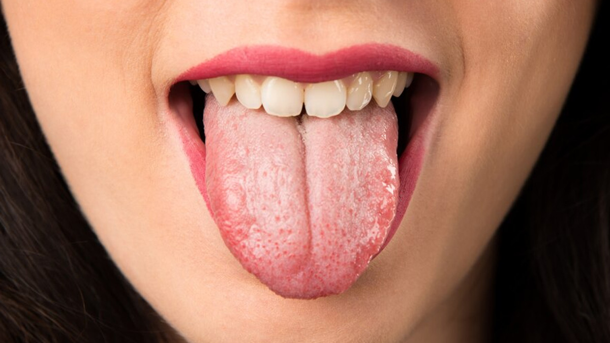 Tips To Fix White Coating On Tongue And Poor Gut Health