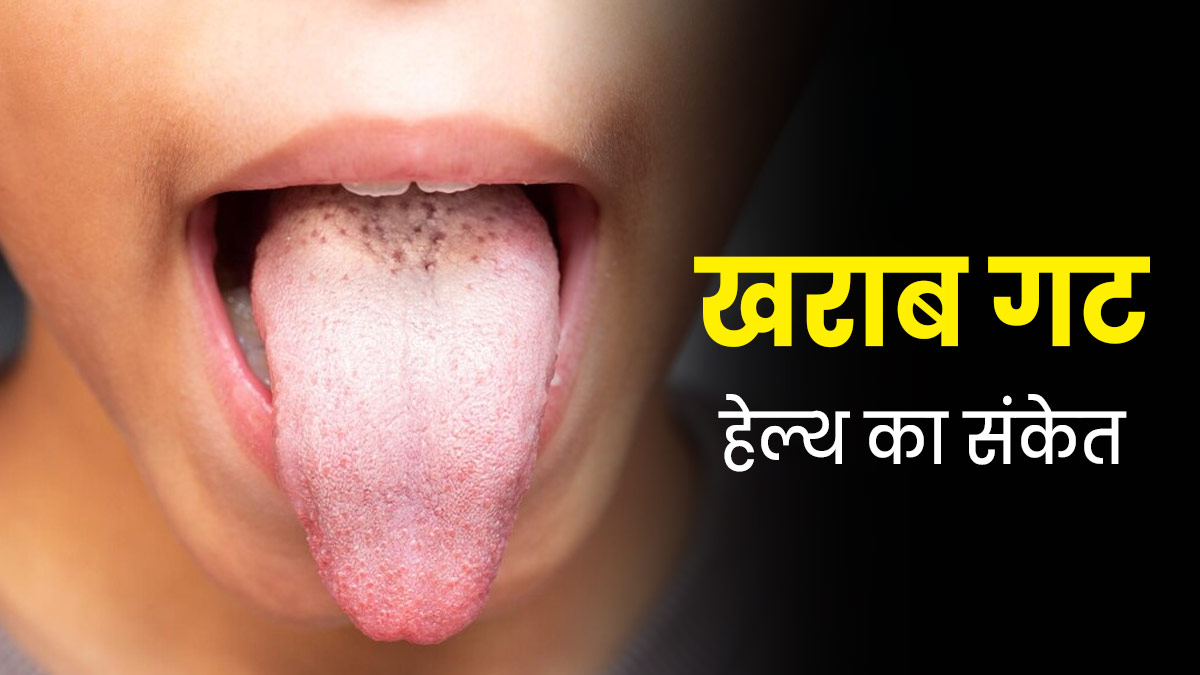 Poor Gut Symptoms: जीभ पर जमी सफेद कोटिंग हो सकती है खराब गट हेल्थ का संकेत, आयुर्वेदाचार्य से जानें उपाय