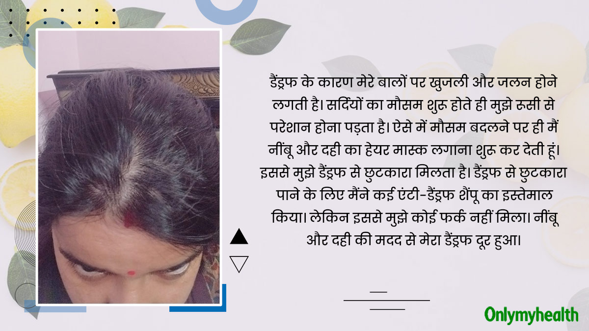 rupali dandruff hair mask