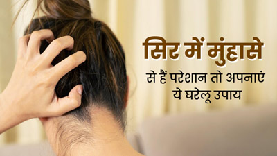 सिर पर हो जाते हैं फोड़े-फुंसियां, तो राहत पाने के लिए अपनाएं ये 5 घरेलू उपाय