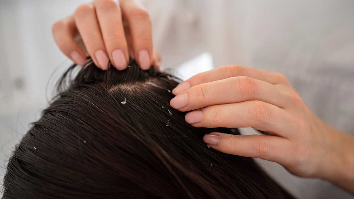 Dry Scalp Vs Dandruff: Experts Explains How To Differentiate Between ...