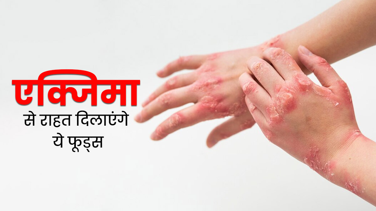 एक्जिमा से राहत पाने के लिए फॉलो करें ये डाइट टिप्स, ये 2 घरेलू उपाय भी आएंगे काम