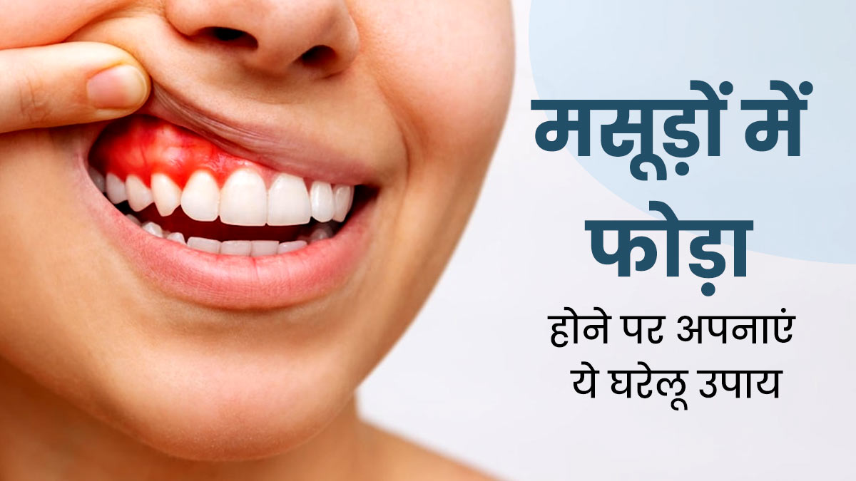 मसूड़ों में फोड़ा हो जाए तो क्या करना चाहिए? जानें 5 घरेलू उपाय जिनसे मिलेगा आराम 