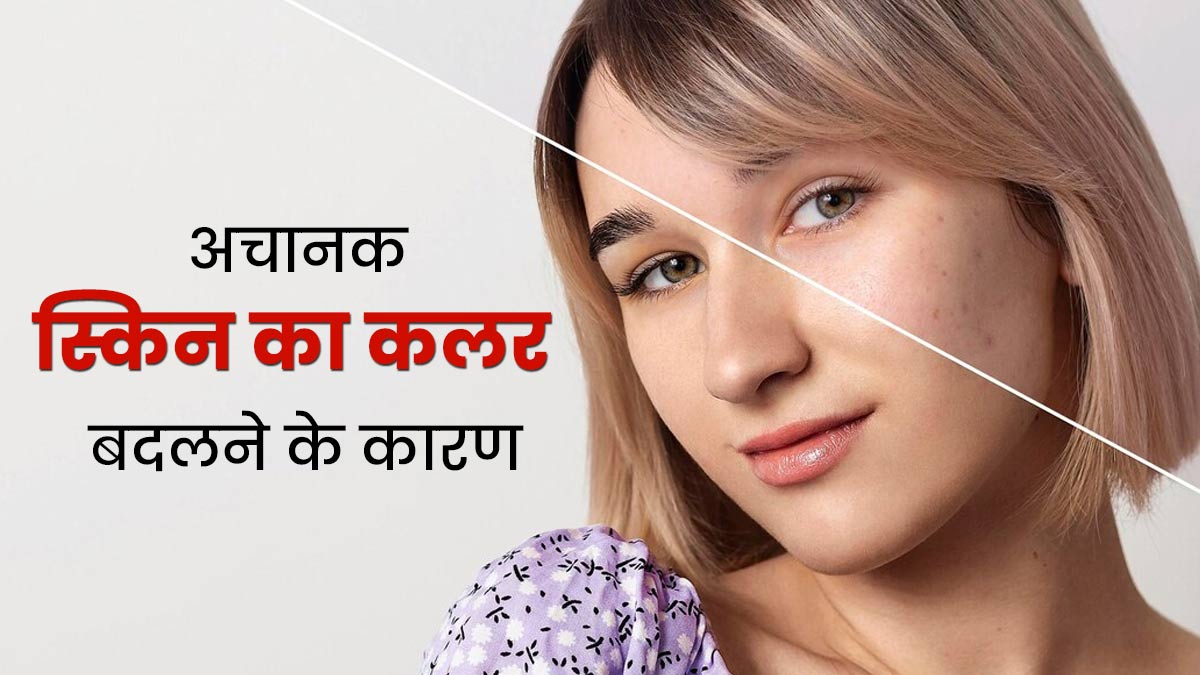 अचानक स्किन का कलर बदलना होना नहीं है सामान्य, इन गंभीर बीमारियों का हो सकता है संकेत